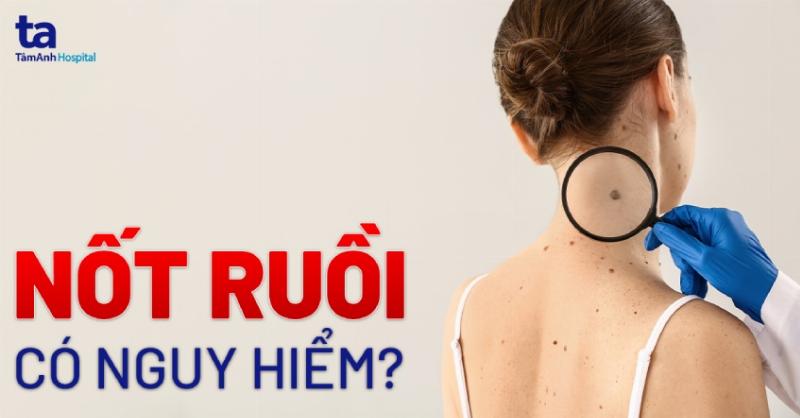 Hinh anh phan biet cac loai not ruoi dua tren mau sac va hinh thai
